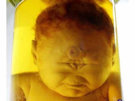 এক চোখের শিশু