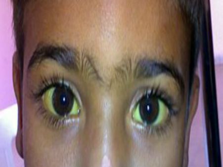 চোখ হলুদ হওয়া