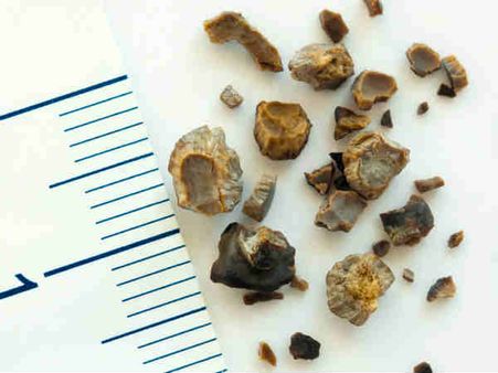 ৮. কিডনি স্টোনের আশঙ্কা কমায়: