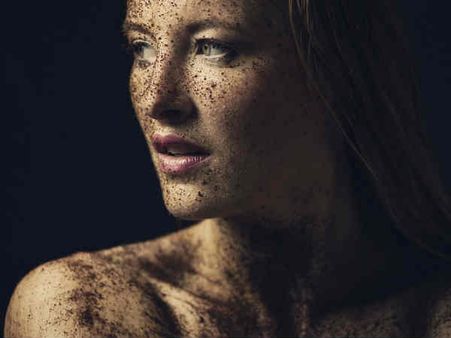 ৫. আঁচিলের চিকিৎসাতেও কাজে আসে: