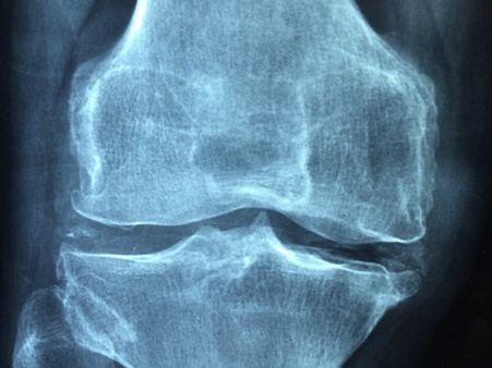 ৫. আর্থ্রাইটিসের যন্ত্রণা কমায়: