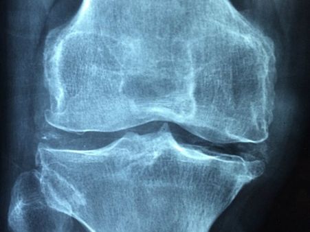 ১. আর্থ্রাইটিস প্রকোপ কমায়: