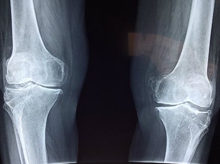 ২. আর্থ্রাইটিস কষ্ট কমায়: