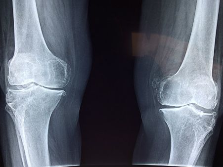 ৩. হাড়ের স্বাস্থ্যের অবনতি ঘটে: