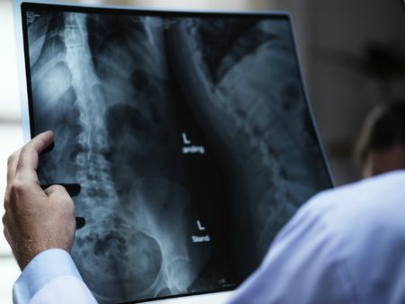 ১১. হাড়ের রোগে আক্রান্ত হওয়ার আশঙ্কা থাকে: