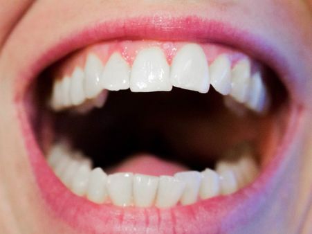 ২. দাঁতের ক্ষতি হয়: