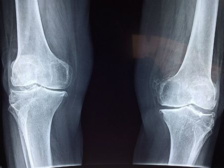 ৪. হাড়ের স্বাস্থ্যের উন্নতি ঘটে: ৪. হাড়ের স্বাস্থ্যের উন্নতি ঘটে: