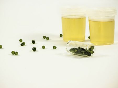 ইউরিনে ফেনা হচ্ছে কেন তা জানতে কী করণীয়: ইউরিনে ফেনা হচ্ছে কেন তা জানতে কী করণীয়: