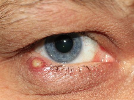 ৩. চোখের সংক্রমণ: