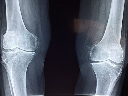 ৬. আর্থ্রাইটিস রোগের কষ্ট কমায়: