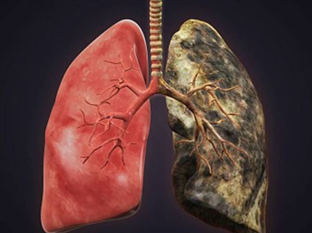 লাং ক্যানসার হওয়ার কারণ কী?