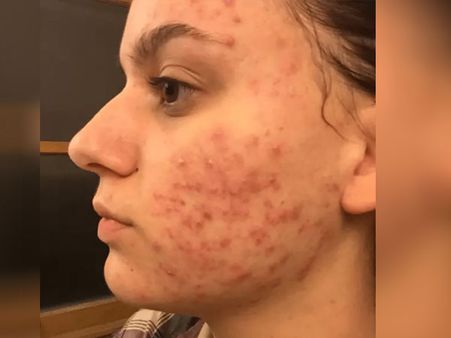 সিস্টিক অ্যাকনি কেন হয়?