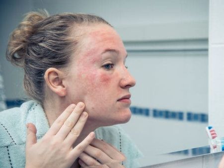 অ্যালার্জি