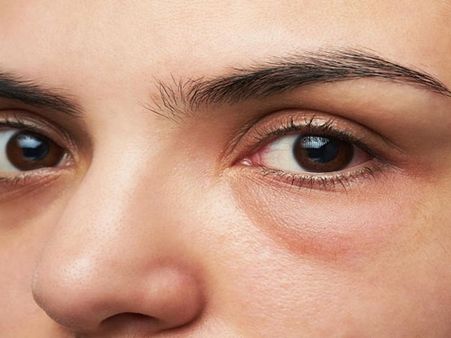 মুখে ফোলাভাব