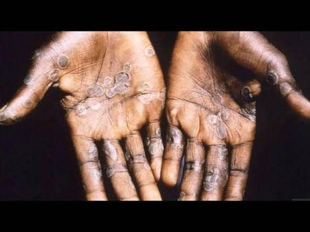 মাঙ্কিপক্সের উপসর্গ