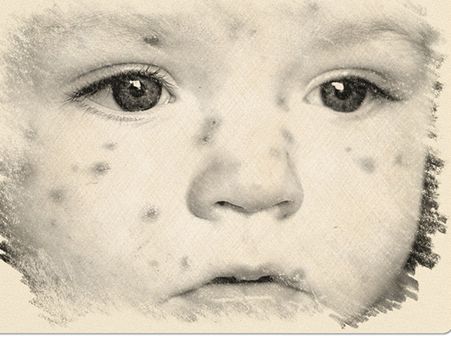 মিজ়লস ও রুবেলার উপসর্গ 