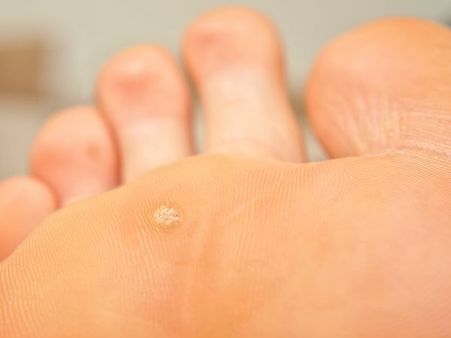 Remove Warts