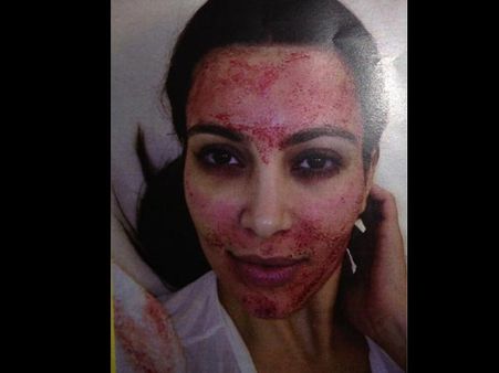 Vampire Facial Vampire Facial