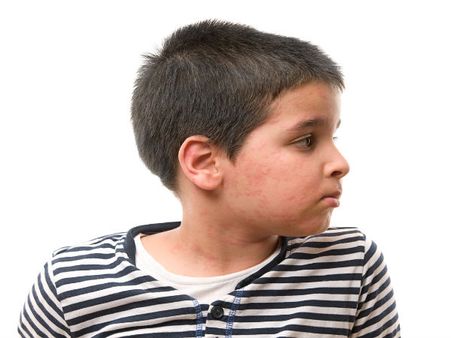 Conjunctivitis Conjunctivitis