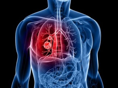 Lung Cancer Lung Cancer