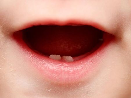 Teething Gums