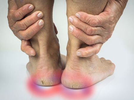  Softens Cracked Heels