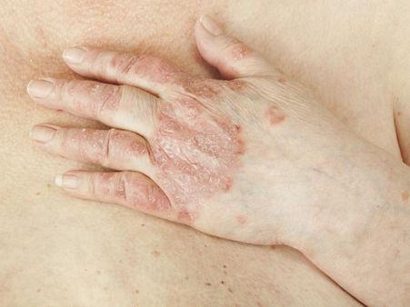 Psoriasis Psoriasis