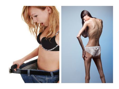 Anorexia Anorexia