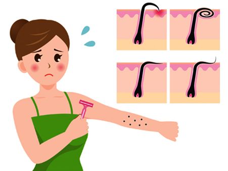 Razor Burn And Ingrowth Of Hair