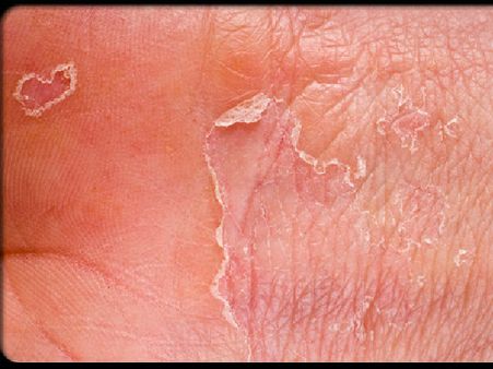 Dry Scaly Patches