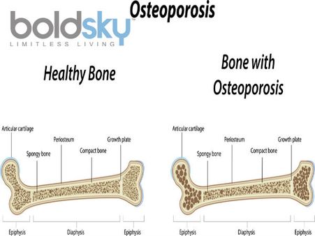Prevents Osteoporosis 