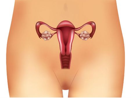 Polycystic Ovary Syndrome (PCOS)