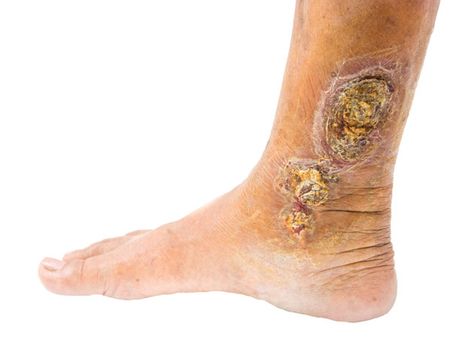 Unhealed Ulcers Unhealed Ulcers