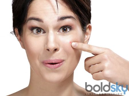 Acne On Cheeks (left)