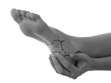 Heals Cracked Heels Heals Cracked Heels