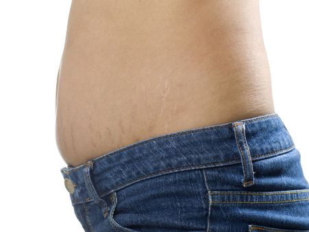 Gets Rid Of Stretch Marks