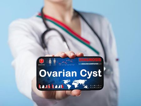 Can Ovarian Cysts Be Prevented
