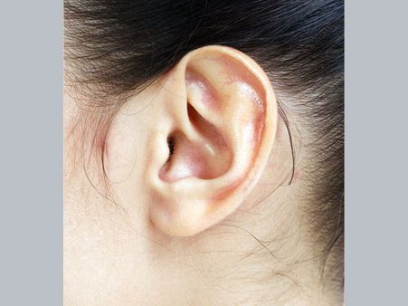 Acne On Ears Acne On Ears