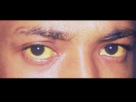 Pale Yellow For Liver Diseases