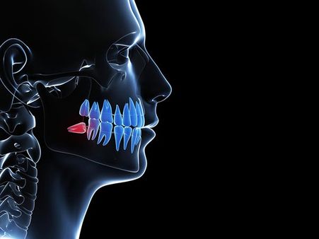 Wisdom Teeth Wisdom Teeth
