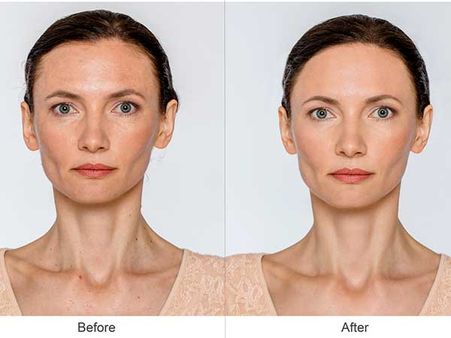 Removes Wrinkles And Tightens Loose Skin