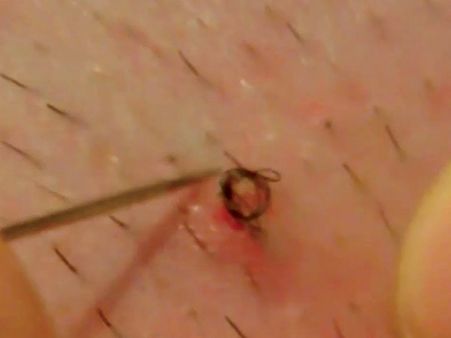 Ingrown Hairs Or Pseudofolliculitis