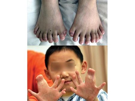 The Boy With 31 Fingers!