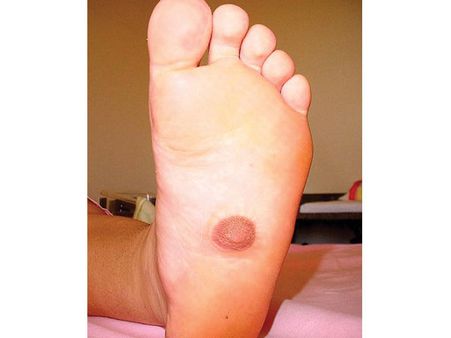 The Woman With A Nipple On Her Foot!