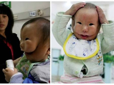 A Baby With A Second Face