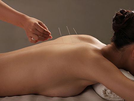 Acupuncture: Acupuncture: