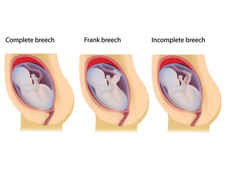 What If It Is In A Breech Position?: 
