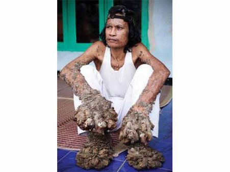 Epidermodysplasia Verruciformis