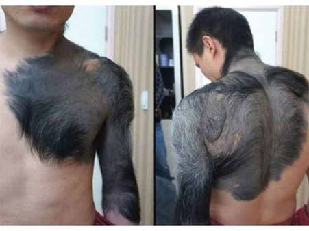 Giant congenital Melanocytic