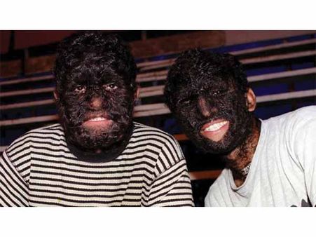 Hypertrichosis